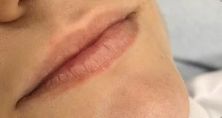 Antes do preenchimento labial: lábios finos e pouco definidos