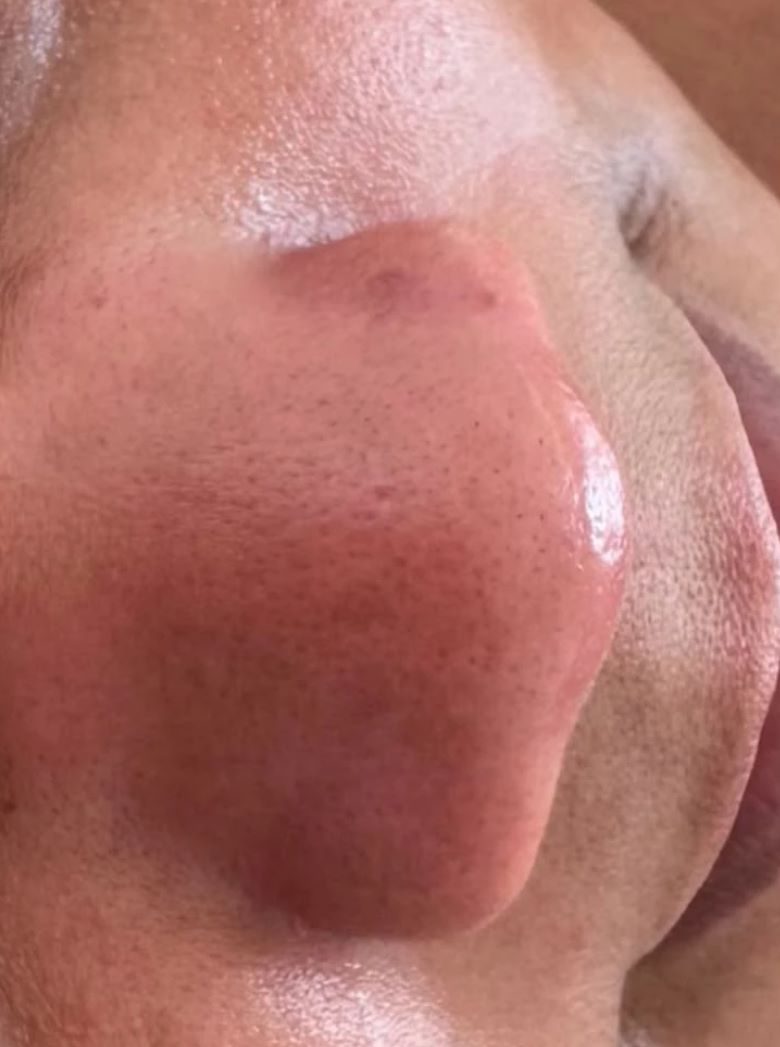 Depois da limpeza de pele: poros do nariz desobstruídos e pele uniforme